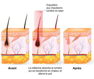 Épilation laser, épilation définitive, injections Botox, acide hyaluronique, cryolipolyse, rajeunissement cutané, relâchement cutané, taches pigmentaires, couperose, erythrose, lasers,83400 Hyères